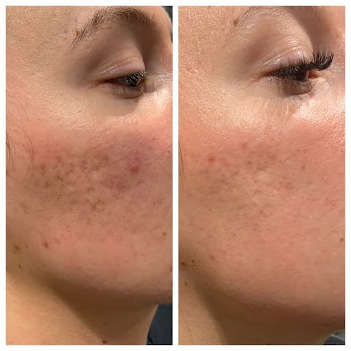 a woman's face with acne
