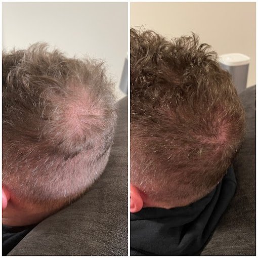portland hair restoration treatments