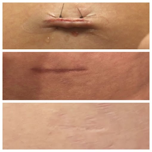 ResurFX Acne Scar Eraser