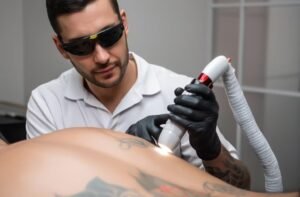 laser tattoo removal