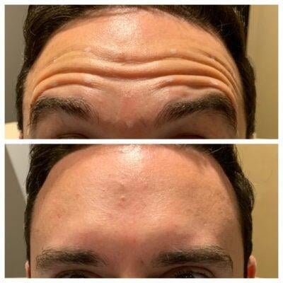 Botox Portland