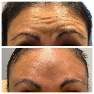 a collage of wrinkles on foreheads Botox Portland