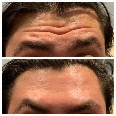 a man's forehead with wrinkles Botox Portland