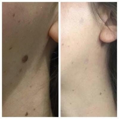 a person's neck with a mole