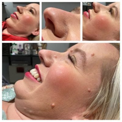 a woman with a pimple on her face