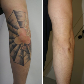Laser Tattoo Removal
