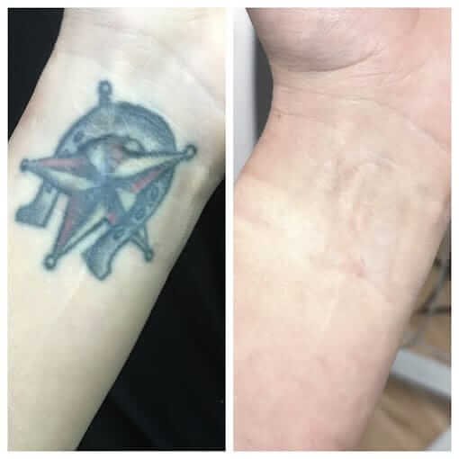 Portland Laser Tattoo Removal