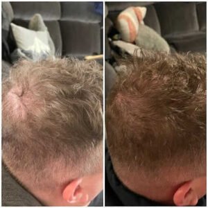 portland hair restoration treatments