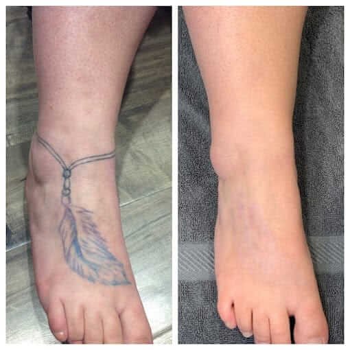 Laser Tattoo Removal